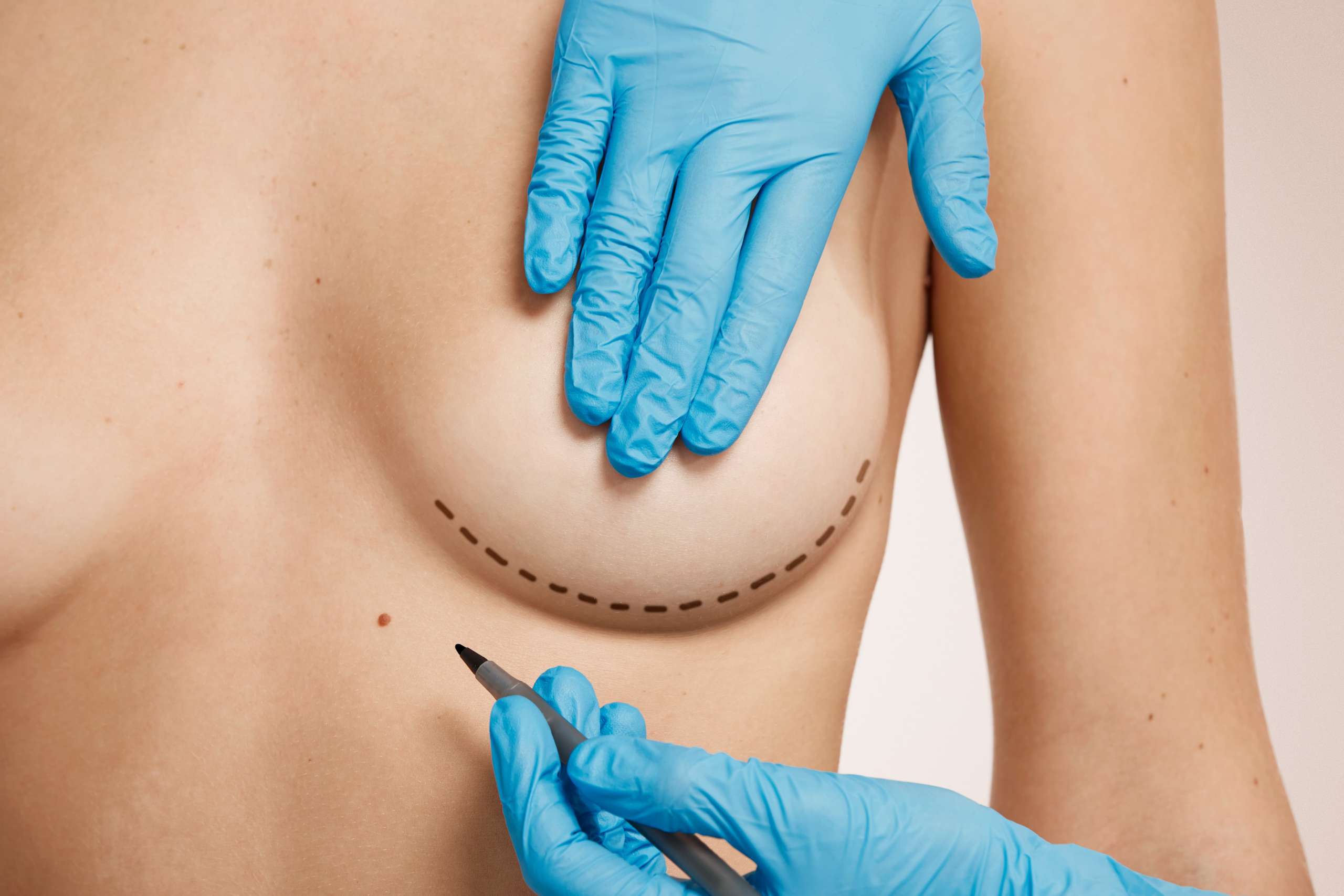 Breast Augmentation